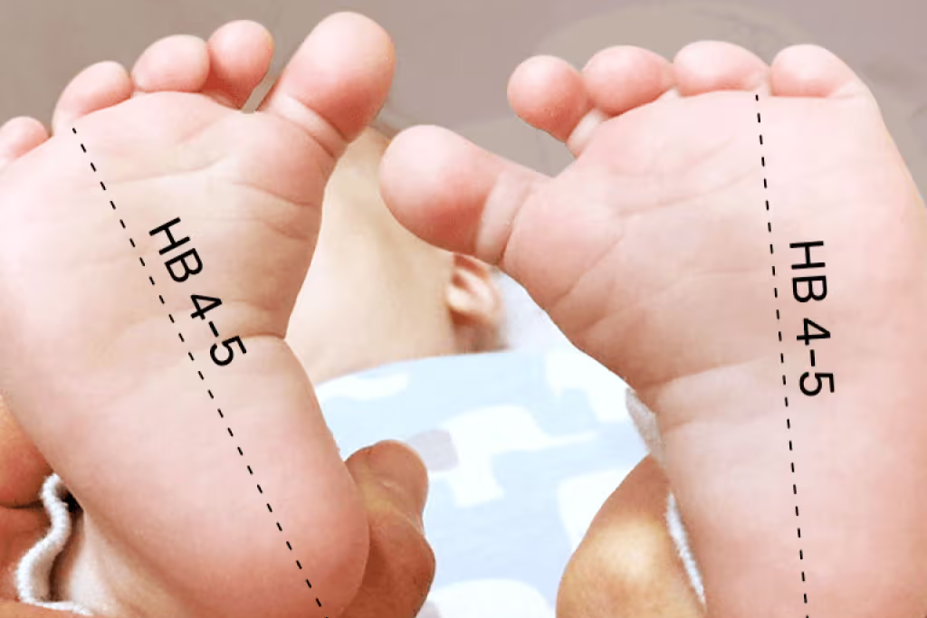 انحراف أصابع القدم