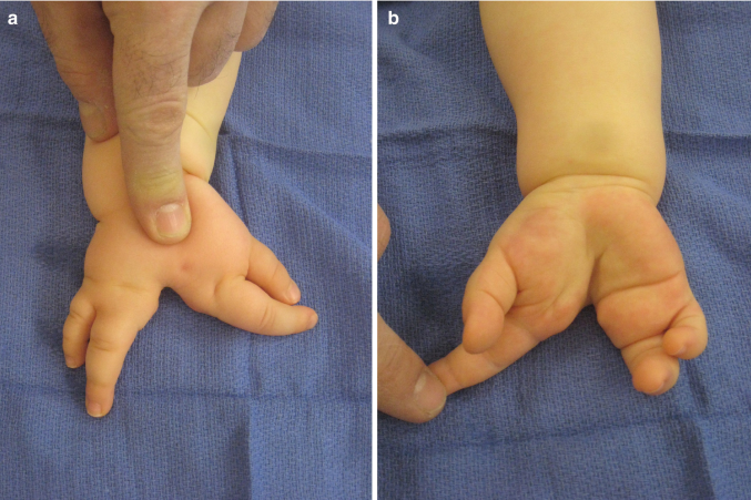 تشوهات أصابع اليد