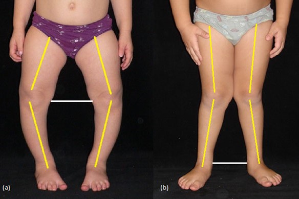 تقوس الساقين