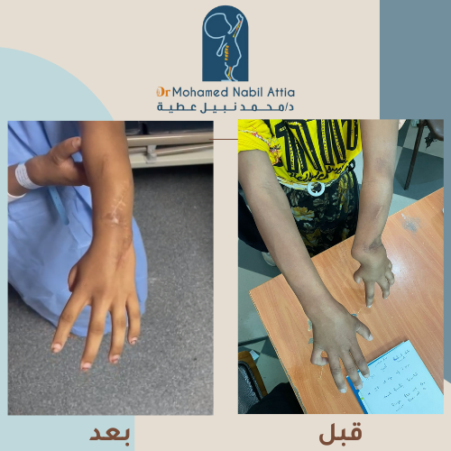تشوهات اليد - حالة ناجحة