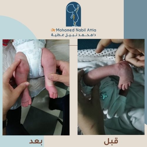 القدم المخلبية - حالة ناجحة