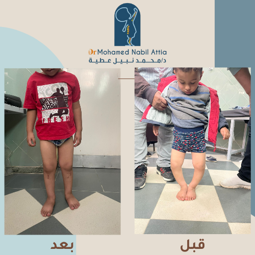 تقوس الساقين - حالة ناجحة