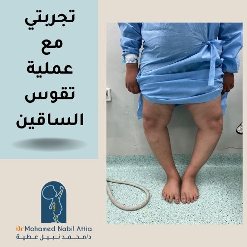 تجربتي مع عملية تقوس الساقين