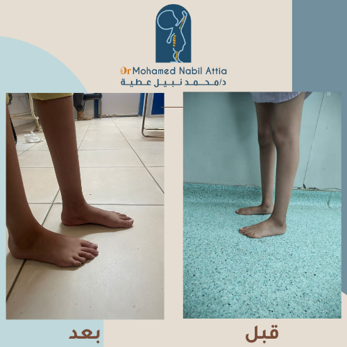 نتائج علاج القدم المسطحة قبل وبعد — د. محمد نبيل