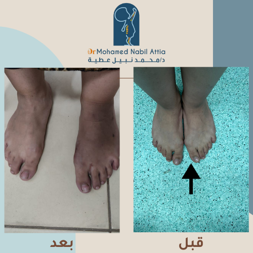 نتائج علاج انحراف إصبع القدم الكبير قبل وبعد — د. محمد نبيل