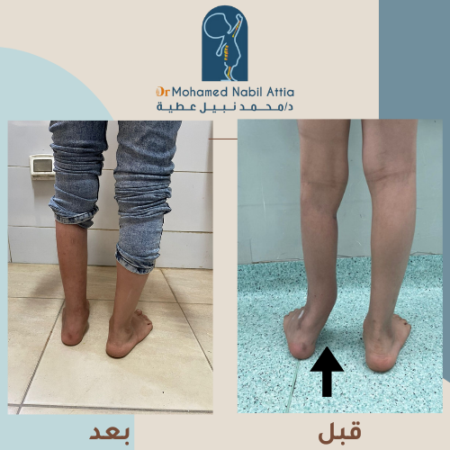 نتائج جراحة تشوهات القدم قبل وبعد — د. محمد نبيل