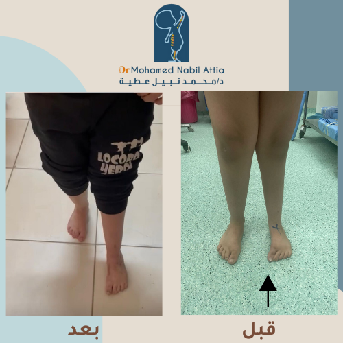 القدم المخلبية عند الأطفال — شكل التشوه الخلقي — د. محمد نبيل