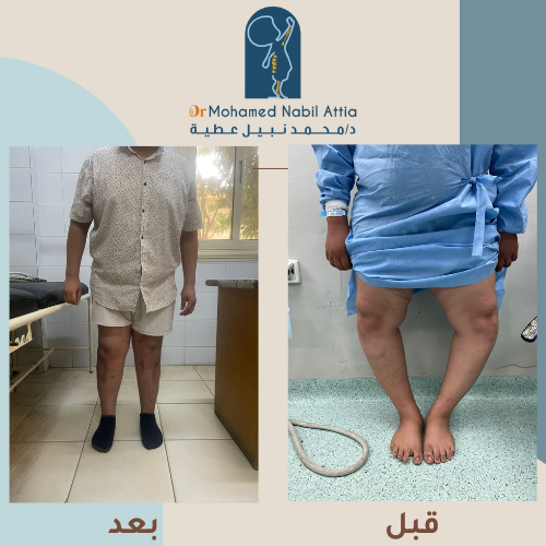 علاج تقوس الساقين للخارج عند الأطفال قبل وبعد