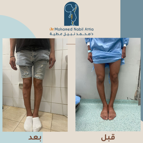 علاج تقوس الساقين عند الأطفال قبل وبعد