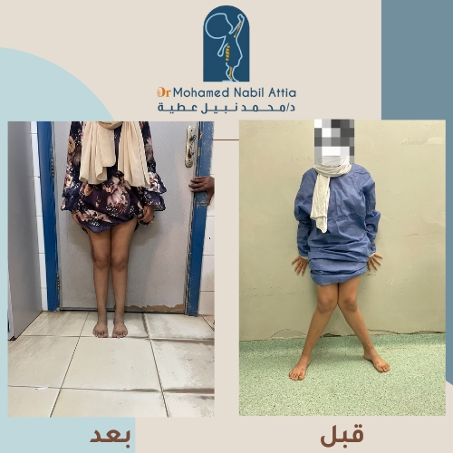 نتيجة علاج تقوس الساقين - د. محمد نبيل عطية