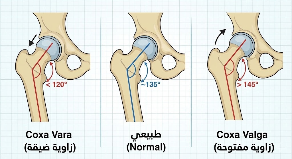 رسم تشريحي يوضح زاوية عنق الفخذ في الحالات المختلفة