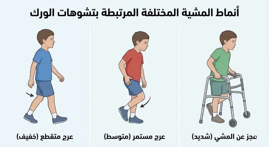        أنماط المشية المختلفة المرتبطة بتشوهات الورك  