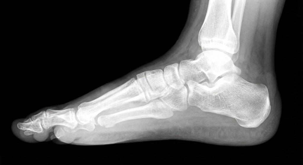 رنين مغناطيسي للقدم - علاج الفلات فوت عند الأطفال