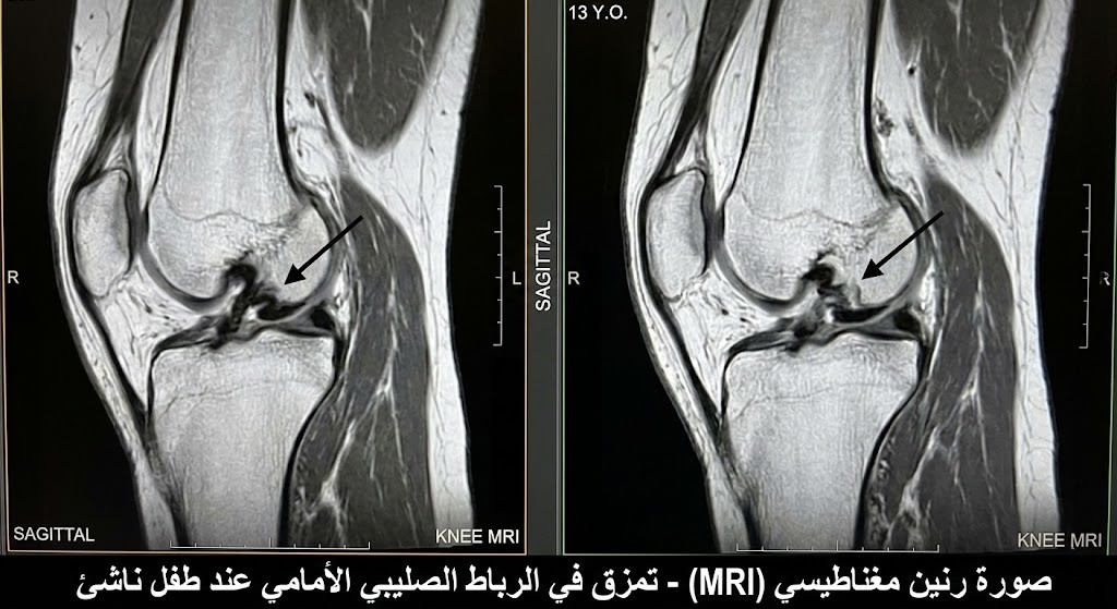 صورة رنين مغناطيسي لركبة طفل توضح إصابة في الرباط الصليبي